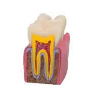 Tooth Decay Model 6 Times Roots Canal Education Supplies Oral Preventive Care